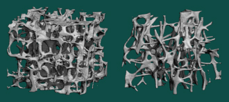 Micro CT images of the spines of a healthy 23-year-old woman (left) and an 85-year-old woman with osteoporosis. The bone trabeculae structure of the 85-year-old woman is deteriorated and the bone mass is reduced. (Courtesy of Dr. Masako Ito, Department of Radiation, Nagasaki University Hospital)